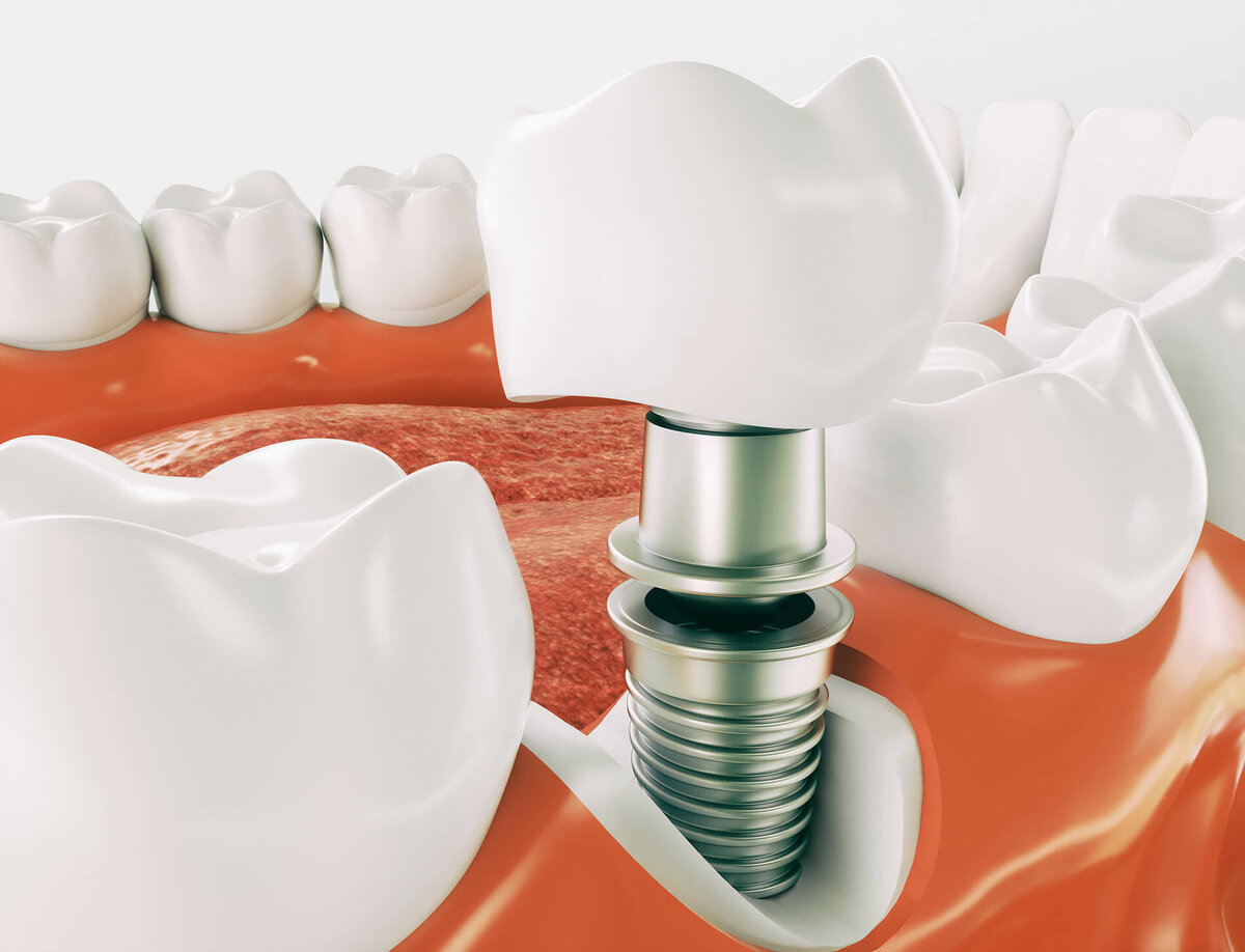 Особенности и преимущества имплантации зубов