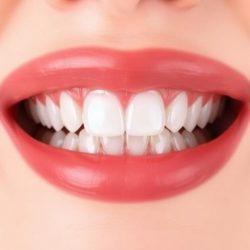 Виниры для зубов: красота, которая не должна выглядеть фальшиво