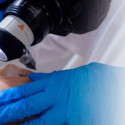 Удаление родинок у дерматолога – современный подход