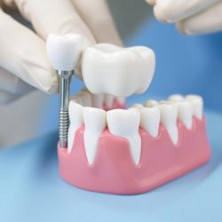 Имплантация зубов: как вернуть улыбку без страха и с пониманием процесса