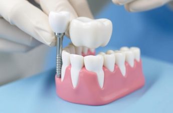Имплантация зубов: как вернуть улыбку без страха и с пониманием процесса