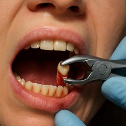 Когда зуб уже не спасти: 5 признаков, что пора к хирургу-стоматологу